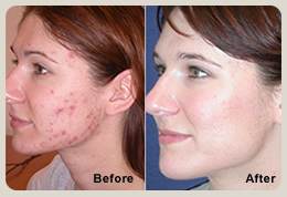 laser treatment results