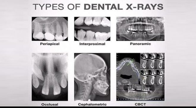 Types of Dental X-RAYS